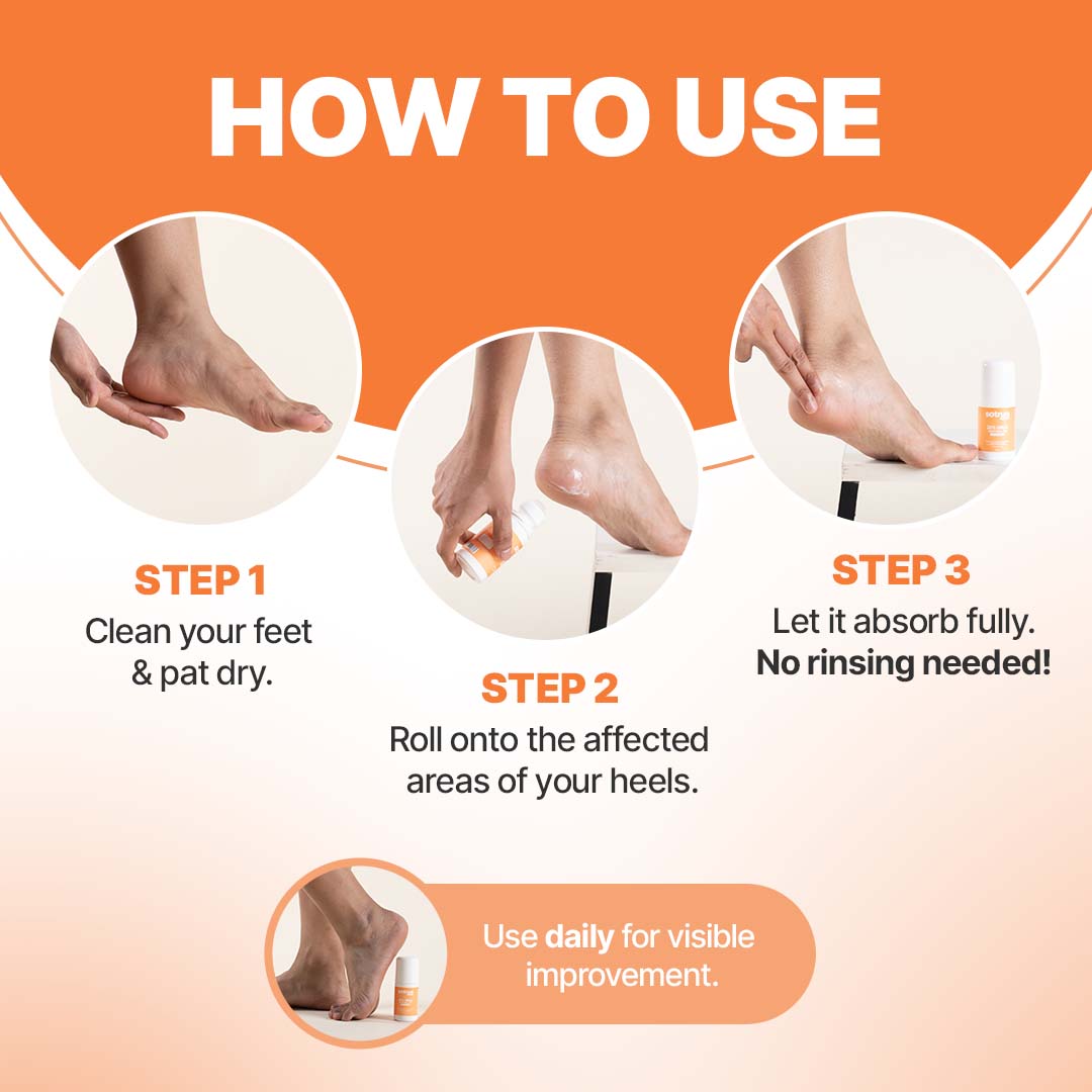 20% Urea Foot Roll-On | Cracked Heel Repair | Intense Hydration | 50 ml