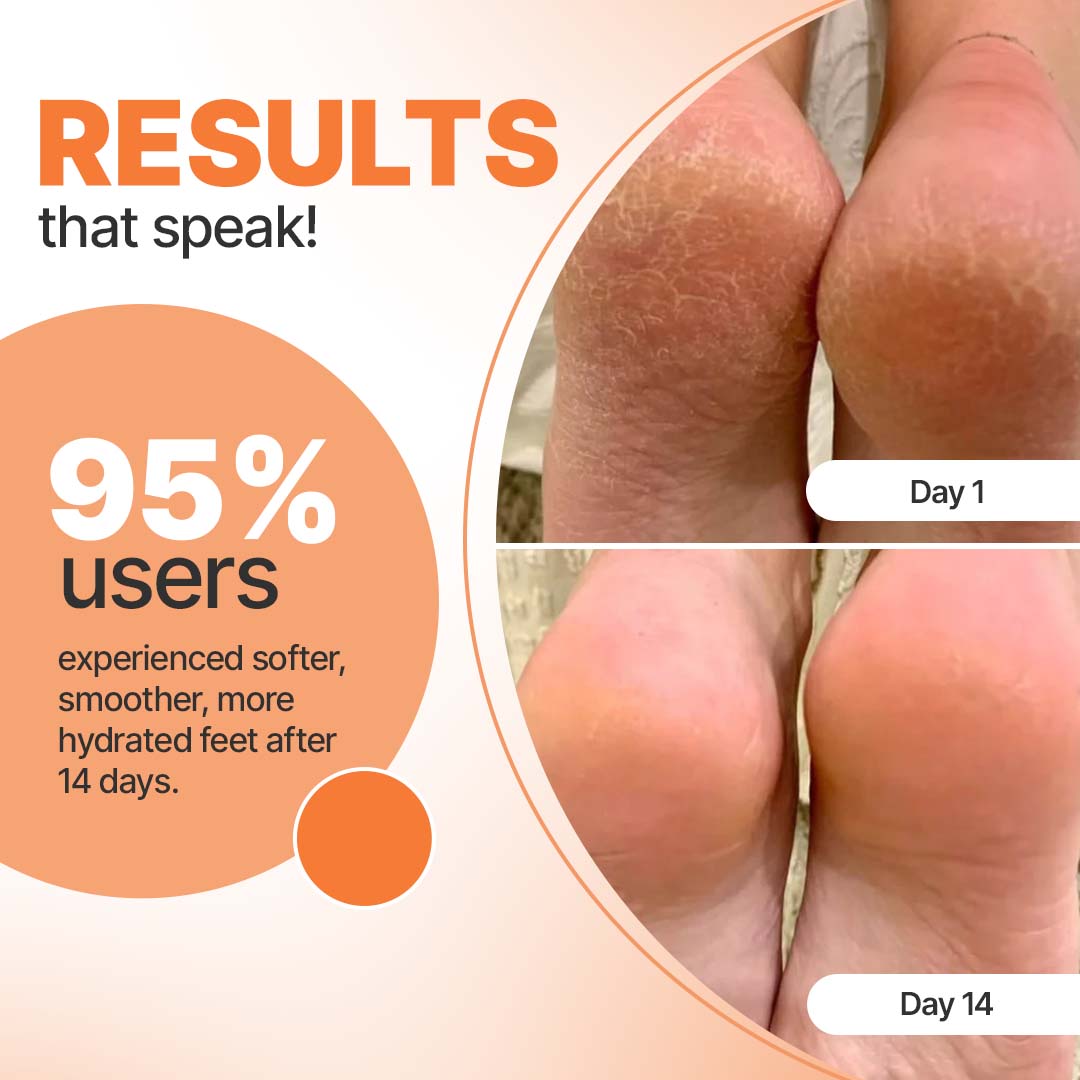20% Urea Foot Roll-On | Cracked Heel Repair | Intense Hydration | 50 ml