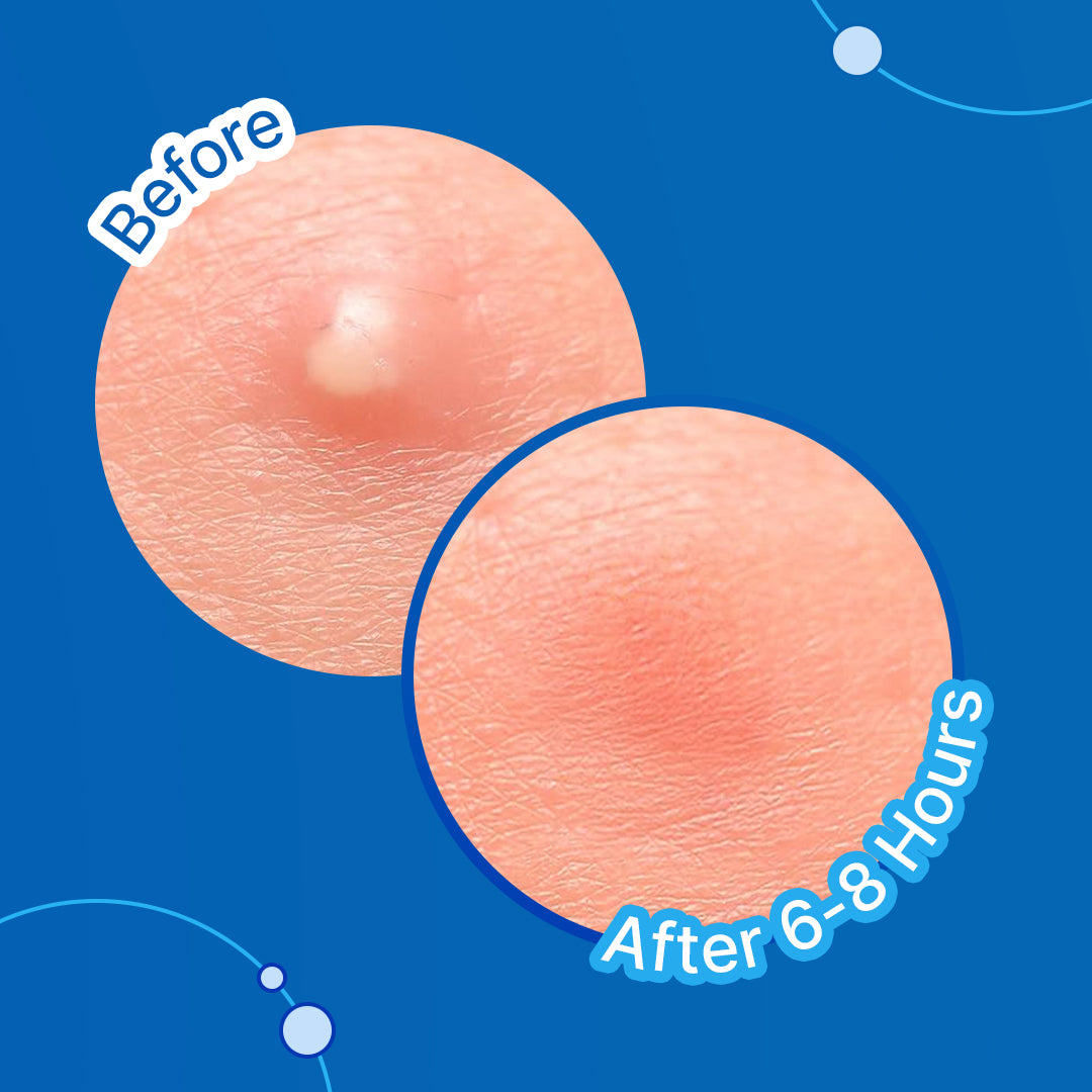 Hydrocolloid Acne Pimple Patch | Salicolloid™ Technology