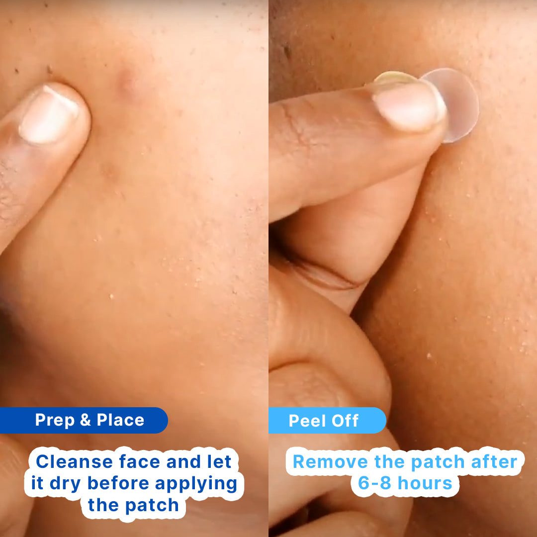Hydrocolloid Acne Pimple Patch | Salicolloid™ Technology