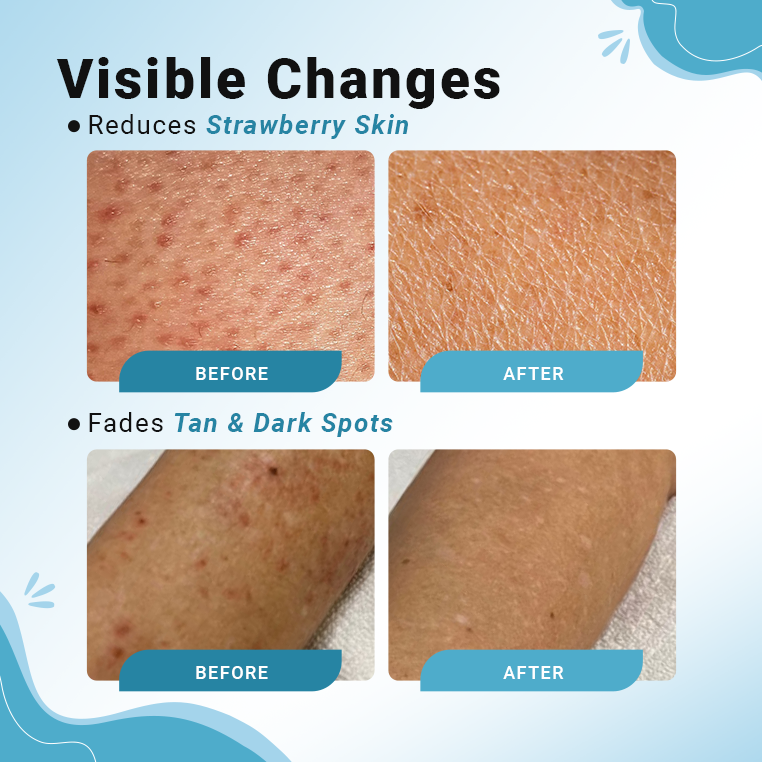 AHA + BHA Body Lotion | Exfoliates, Hydrates & Brightens Skin | 200Ml